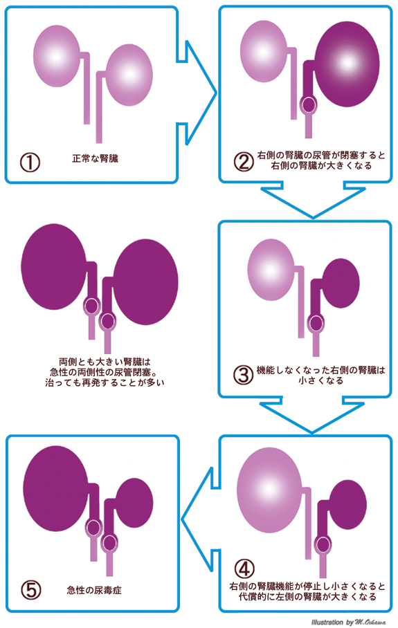 大きい腎臓と小さい腎臓の症候群